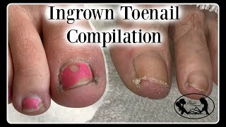 Satisfying Ingrown Toenail Pedicure Compilation [upl. by Haila]