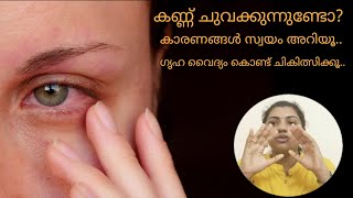 101 കണ്ണുചുവപ്പ് കാരണങ്ങൾ സ്വയം മനസ്സിലാക്കാം  ശ്രദ്ധിക്കേണ്ട കാര്യങ്ങൾ  DrAmritha Mohan [upl. by Atinus382]