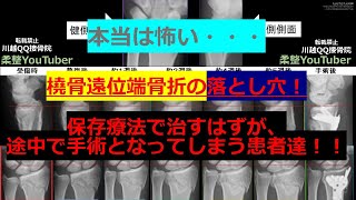 手首骨折橈骨遠位端骨折の治療途中で手術になる事例 全国民必見！ [upl. by Eirrehc]