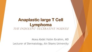 7 Anaplastic Large T Cell Lymphoma  The Indolent Ulcerative Nodule [upl. by Ayekahs167]