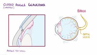 Glaucoma openangle closedangle and normaltension  pathology diagnosis treatment [upl. by Bartosch504]