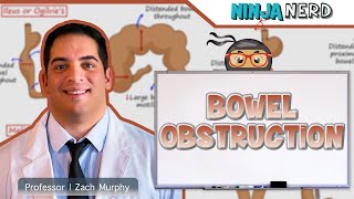 Bowel Obstruction  Clinical Medicine [upl. by Latini]