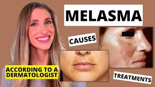 Best Melasma Treatment Dermatologist Explains Melasma Causes At Home Treatments amp More [upl. by Dijam]