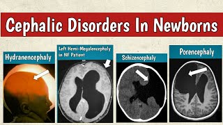 Cephalic Disorders In Newborns  Congenital Brain Malformations Radiology [upl. by Aztirak]