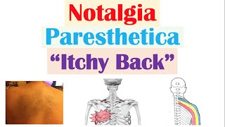 Notalgia Paresthetica “Itchy Back”  Causes Risk Factors Symptoms Diagnosis Treatment [upl. by Artinek]