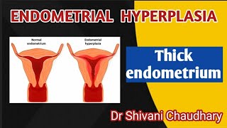 Endometrial hyperplasia  Thick endometrium heavybleeding uterus [upl. by Cusack]