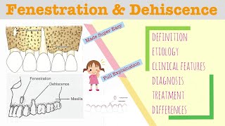 Fenestration and Dehiscence I Periodontology Lectures [upl. by Alveta]