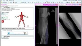 Trauma  Tutorial  Materialise OrthoView [upl. by Archambault]