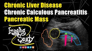 Chronic Liver Disease  Chronic Calculous Pancreatitis  Pancreatic Mass  Ultrasound  Case 189 [upl. by Troyes]