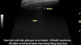 Case 132  Chilaiditi syndrome  Riedel lobe [upl. by Abel]