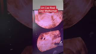 Un Caz Real Uter Malformat [upl. by Wallraff]