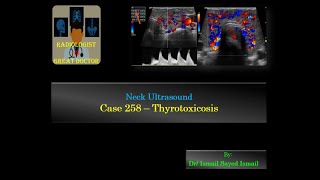 Ultrasound Case 258  Thyrotoxicosis [upl. by Maryrose196]