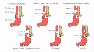 Esophageal Atresia  What is Esophageal Atresia [upl. by Joann]