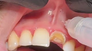 Local Anesthesia For Extraction Upper Central incisor  anterior superior and nasopalatine nerve [upl. by Keligot548]