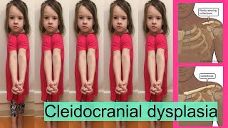 cleidocranial dysplasia [upl. by Hortensia]