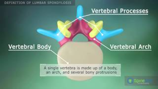 Lumbar Spondylosis Definition [upl. by Gay]