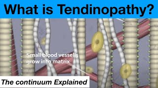 The Tendinopathy Tendon Tendonitis Continuum Theory Explained [upl. by Haraz582]