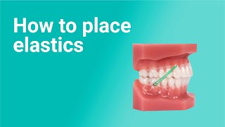 How to Place Elastics with Clear Aligners 9 Ortho Pro techniques [upl. by Bohlen]