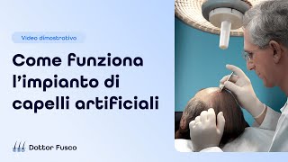 Come funziona limpianto di capelli artificiali [upl. by Elbertina]