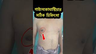 Gynecomastia Surgery  35k Campaign Result  Gynecomastia Treatment Bangladesh [upl. by Waynant]