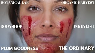 TOP 22 AFFORDABLE SKINCARE THAT WORKS LIKE LUXURY  BEFOREAFTER ACNE RESULTS BEST OF THE ORDINARY [upl. by Notgnirrac]