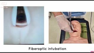 Fiberoptic intubation [upl. by Torrell250]