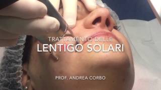 Lentigo Solari  Trattamento con Laser frazionato CO2 [upl. by Lauri]