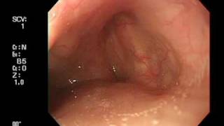 Endoscoe insertion from right pyriform sinus [upl. by Deppy866]