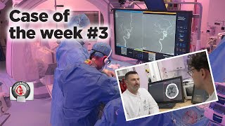 Case of the week 3  CTPerfusion and ADAPTQUATTRO for MeVO occlusions [upl. by Anirtac650]