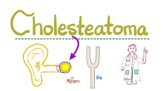 Hearing Loss Deafness  Cholesteatoma  Causes Symptoms Diagnosis amp Treatment  ENT  Pathology [upl. by Rexfourd]