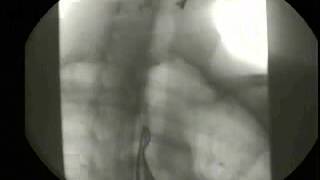 deo 1  Videofluoroscopy of deglutition and primary peristalsis [upl. by Earas75]