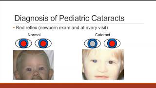 Pediatric Cataract [upl. by Cloots]