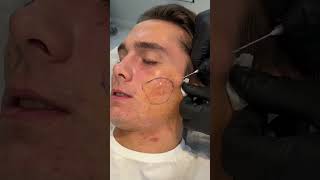 Atrophic Acne Scar Treatment with Dr Qazi acnescarremoval [upl. by Leihcar]