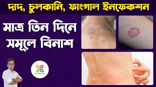 6 Home Remedies for Itching Problem In Private Parts Skin Fungal Infection দাদহাজাচুলকানি । [upl. by Nae381]