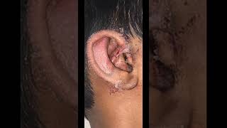 cup deformity of right ear 👂 [upl. by Shelden654]