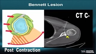 Shoulder InstabilityMRI Part VII Bennett Lesion POLPSA Capsulolabral Rents [upl. by Jonell]