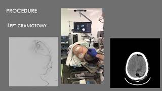 AANS Coding Shorts Craniotomy for Resection of a Meningioma [upl. by Ok]