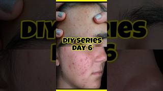 DIY series  Day 6 Get rid of acne and pimples at home diy neem face pack shorts skincare [upl. by Ilahtan652]