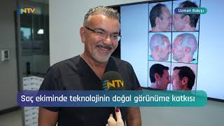 Saç Ekiminde Doğal Bir Görünüm Mümkün mü hairtransplant hairstyle asmed korayerdogan [upl. by Laurance]