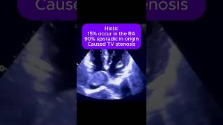 Diagnosis echocardiography rightatrialmyxoma [upl. by Ulphia]