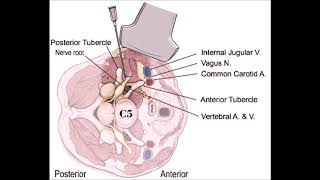 UltrasoundGuided Injection to the Fifth Cervical Spine Nerve Root Level [upl. by Gnok]