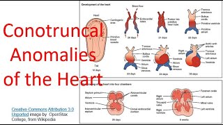 Conotruncal anomalies of the heart [upl. by Neelyt]