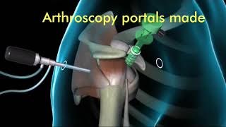 Arthroscopic Bankart Repair Animation [upl. by Reamonn]