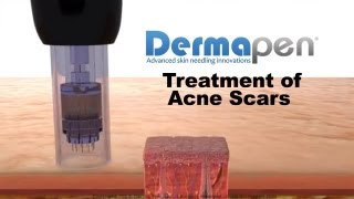 MicroNeedling for Acne Scars  Dermapen® Treatment [upl. by Enimrac]