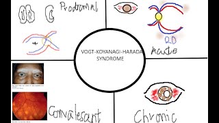 VOGT KOYANAGI HARADA SYNDROME KanskiSeries 2022 [upl. by Rinaldo494]