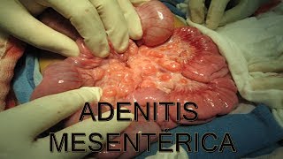 ADENITIS MESENTERICA  MEDICINA HUMANA  MediCiencia [upl. by Kcin]