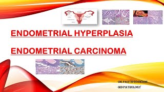 Endometrial Carcinoma amp Endometrial Hyperplasia [upl. by Notsgnik]