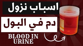 27اسباب نزول الدم في البول Hematuria amp Hemoglobinuria وتفسير العلاقة بين الدم والشريط والميكروسكوب [upl. by Iharas362]