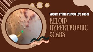 Vbeam Prima Pulsed Dye Laser  Keloid Hypertrophic Scars  West Hollywood CA  Dr Jason Emer [upl. by Jennie311]