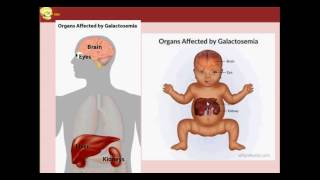 CLASE 11 metabolismo de la galactosa galactosemias [upl. by Grady597]